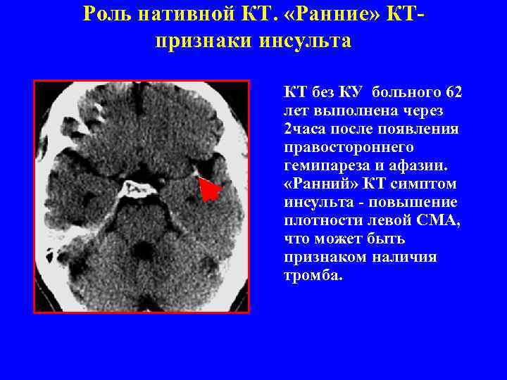 Роль нативной КТ. «Ранние» КТпризнаки инсульта КТ без КУ больного 62 лет выполнена через