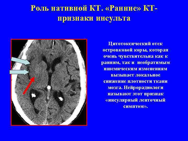 Роль нативной КТ. «Ранние» КТпризнаки инсульта Цитотоксический отек островковой коры, которая очень чувствительна как