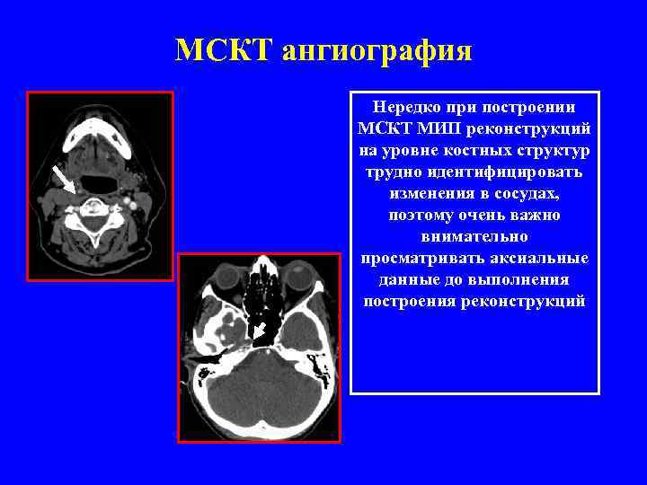 МСКТ ангиография Нередко при построении МСКТ МИП реконструкций на уровне костных структур трудно идентифицировать