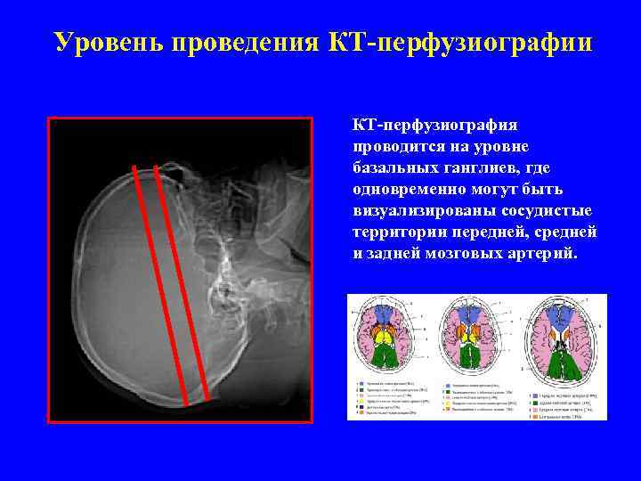 Уровень проведения КТ-перфузиографии КТ-перфузиография проводится на уровне базальных ганглиев, где одновременно могут быть визуализированы