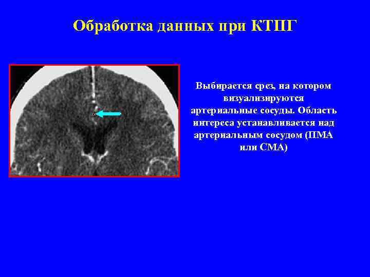 Обработка данных при КТПГ Выбирается срез, на котором визуализируются артериальные сосуды. Область интереса устанавливается