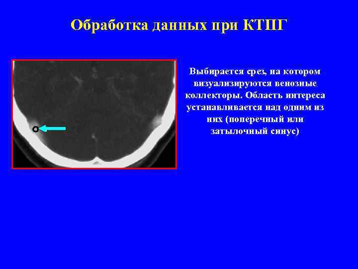 Обработка данных при КТПГ Выбирается срез, на котором визуализируются венозные коллекторы. Область интереса устанавливается