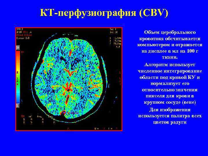 КТ-перфузиография (CBV) Объем церебрального кровотока обсчитывается компьютером и отражается на дисплее в мл на