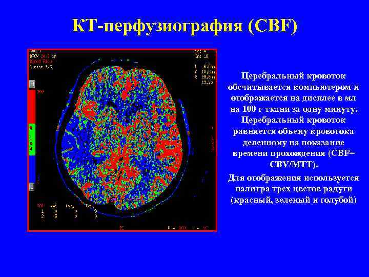 КТ-перфузиография (CBF) Церебральный кровоток обсчитывается компьютером и отображается на дисплее в мл на 100