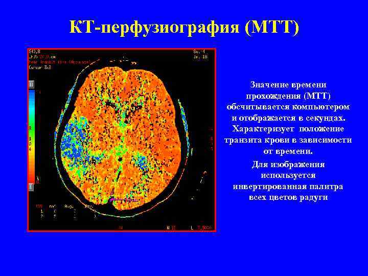 КТ-перфузиография (MTT) Значение времени прохождения (МТТ) обсчитывается компьютером и отображается в секундах. Характеризует положение