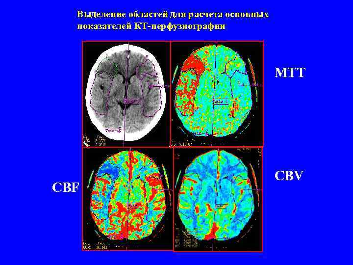 Выделение областей для расчета основных показателей КТ-перфузиографии MTT CBF CBV 