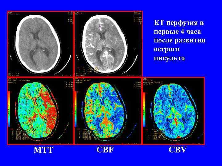 КТ перфузия в первые 4 часа после развития острого инсульта MTT CBF CBV 