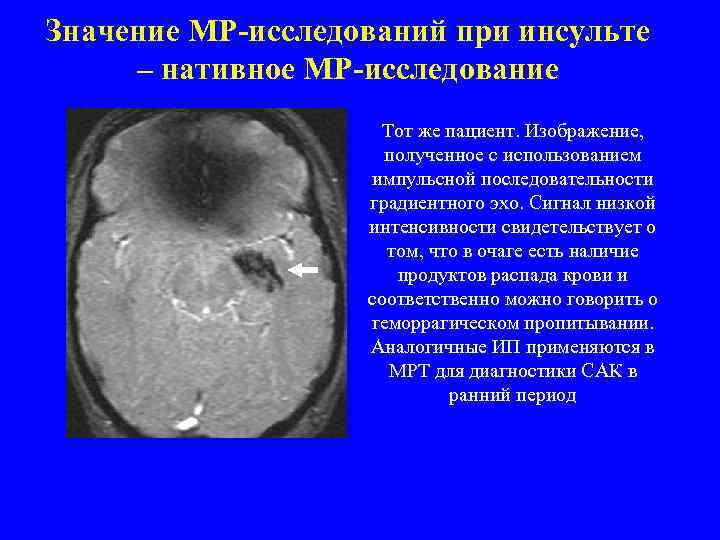 Значение МР-исследований при инсульте – нативное МР-исследование Тот же пациент. Изображение, полученное с использованием