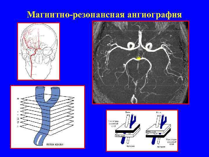 Магнитно-резонансная ангиография 