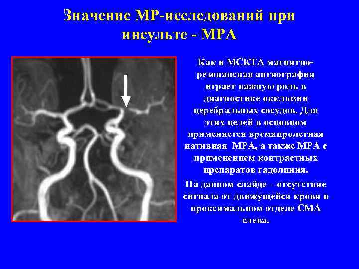 Значение МР-исследований при инсульте - МРА Как и МСКТА магнитнорезонансная ангиография играет важную роль