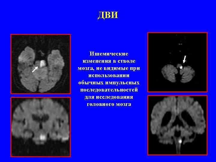 ДВИ Ишемические изменения в стволе мозга, не видимые при использовании обычных импульсных последовательностей для