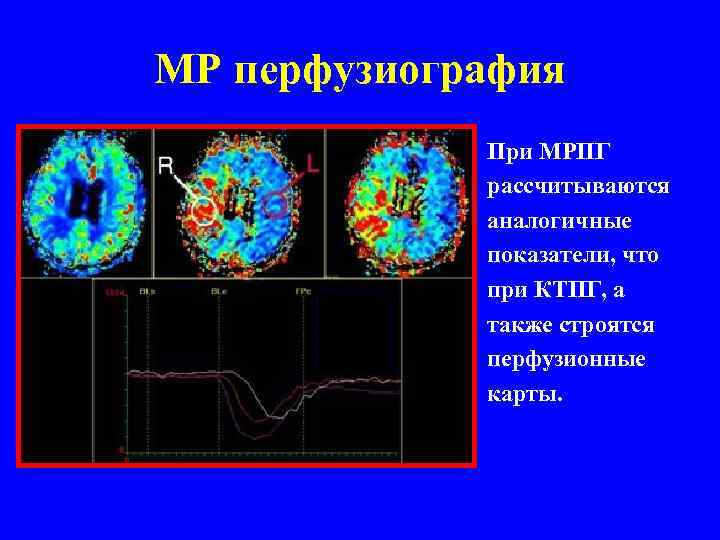 МР перфузиография При МРПГ рассчитываются аналогичные показатели, что при КТПГ, а также строятся перфузионные