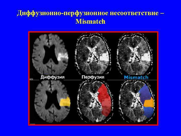 Диффузионно-перфузионное несоответствие – Mismatch Диффузия Перфузия 