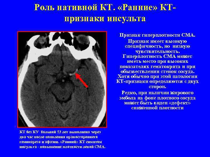 Роль нативной КТ. «Ранние» КТпризнаки инсульта Признак гиперплотности СМА. Признак имеет высокую специфичность, но