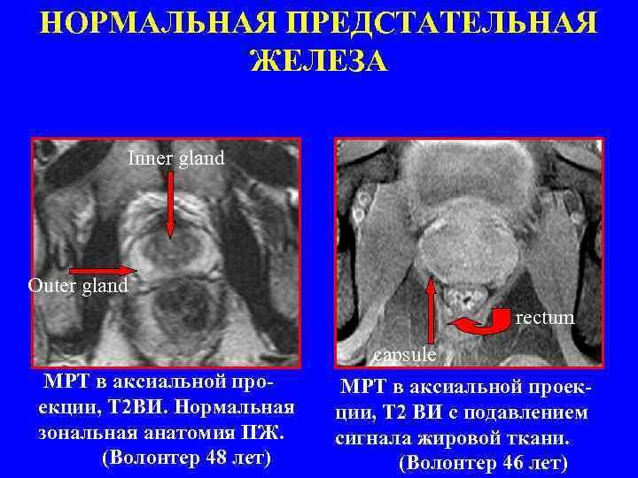 НОРМАЛЬНАЯ ПРЕДСТАТЕЛЬНАЯ ЖЕЛЕЗА Inner gland Outer gland rectum МРТ в аксиальной проекции, Т 2