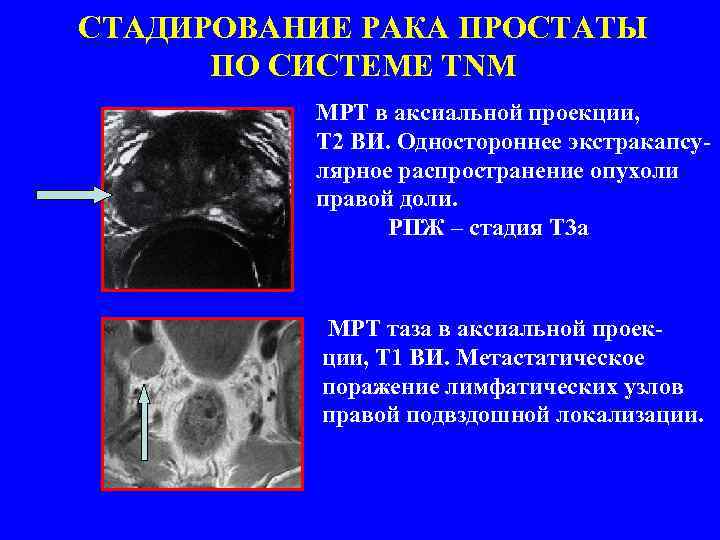 СТАДИРОВАНИЕ РАКА ПРОСТАТЫ ПО СИСТЕМЕ TNM МРТ в аксиальной проекции, Т 2 ВИ. Одностороннее