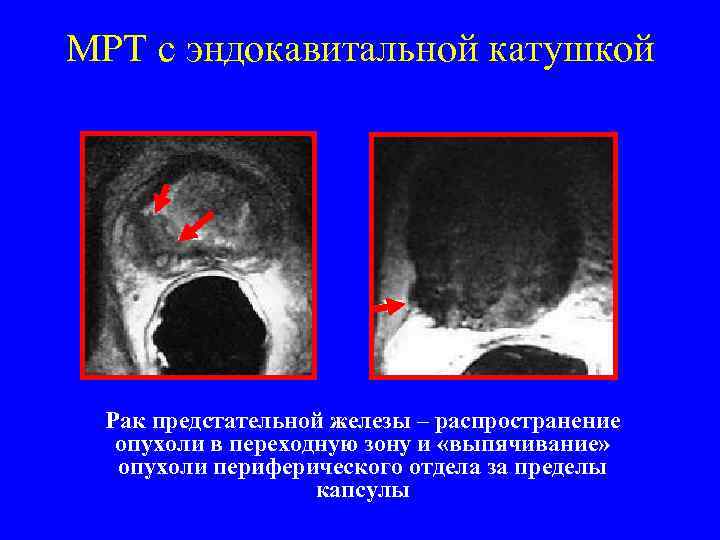 Схема предстательной железы мрт