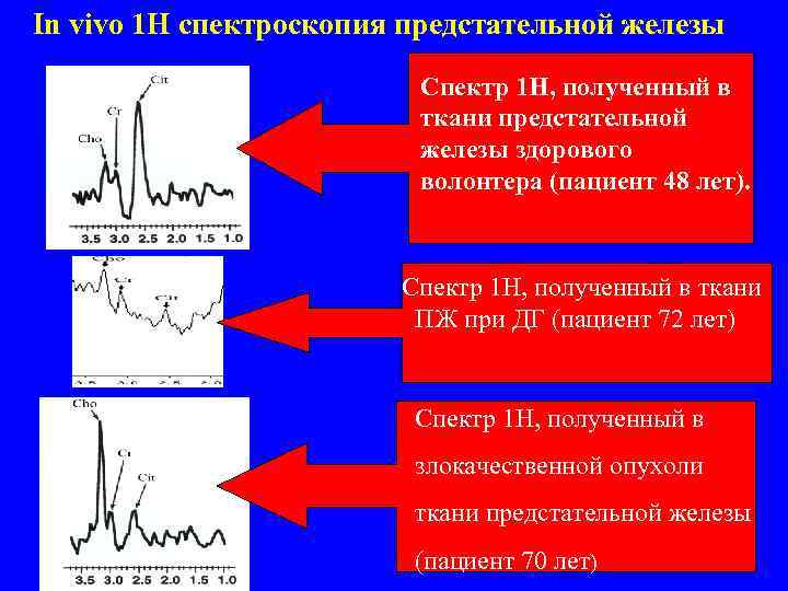 In vivo 1 H спектроскопия предстательной железы Спектр 1 Н, полученный в ткани предстательной