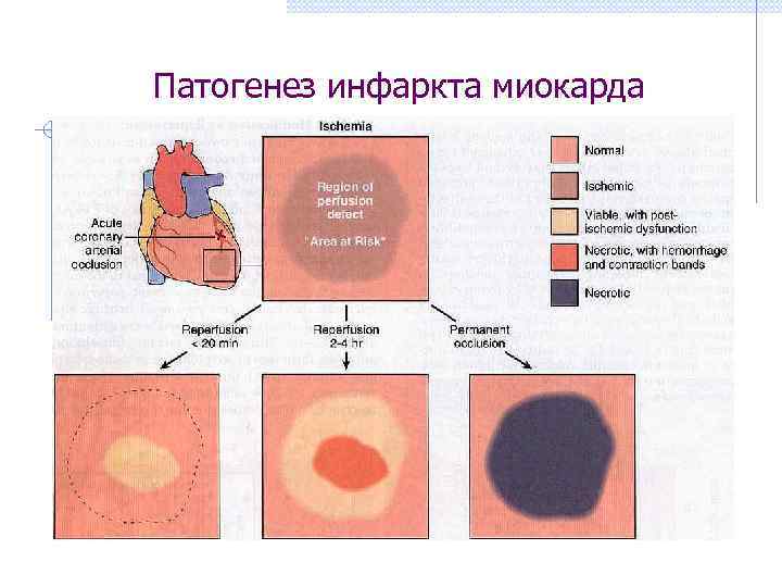  Патогенез инфаркта миокарда 