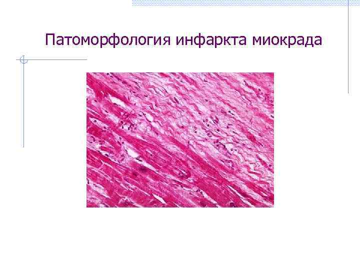  Патоморфология инфаркта миокрада 