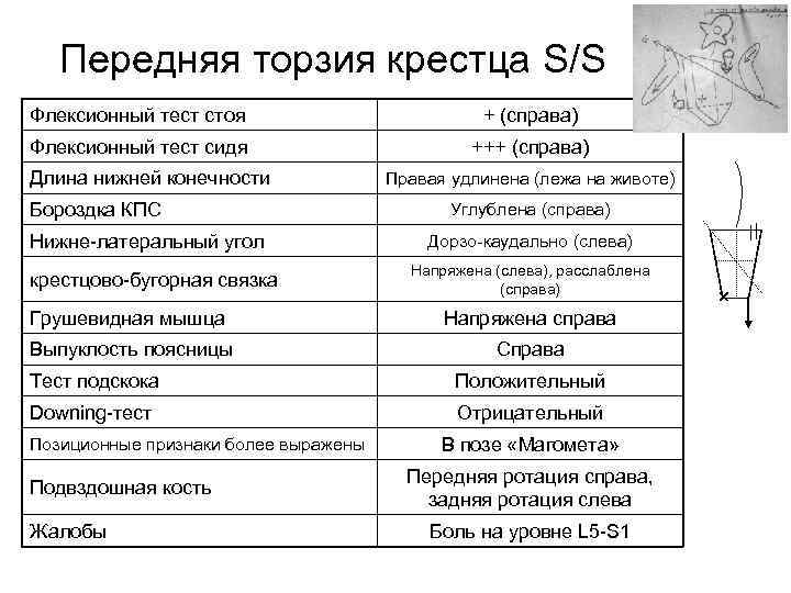 Передняя торзия крестца S/S Флексионный тест стоя + (справа) Флексионный тест сидя +++ (справа)