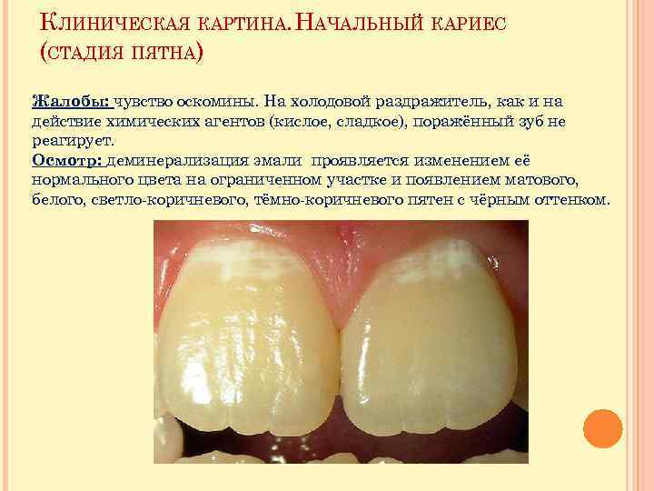 КЛИНИЧЕСКАЯ КАРТИНА. НАЧАЛЬНЫЙ КАРИЕС (СТАДИЯ ПЯТНА) Жалобы: чувство оскомины. На холодовой раздражитель, как и