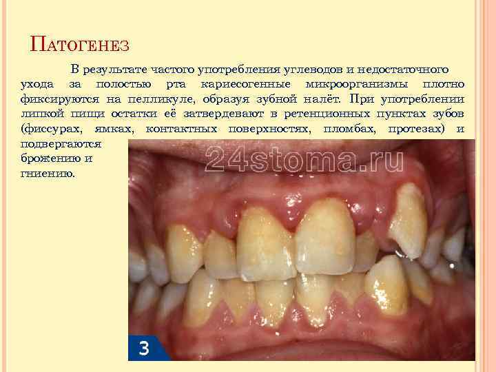 ПАТОГЕНЕЗ В результате частого употребления углеводов и недостаточного ухода за полостью рта кариесогенные микроорганизмы