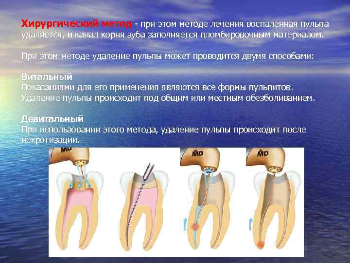 Хирургический метод - при этом методе лечения воспаленная пульпа удаляется, и канал корня зуба