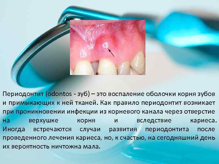 Периодонтит (odontos - зуб) – это воспаление оболочки корня зубов и примыкающих к ней
