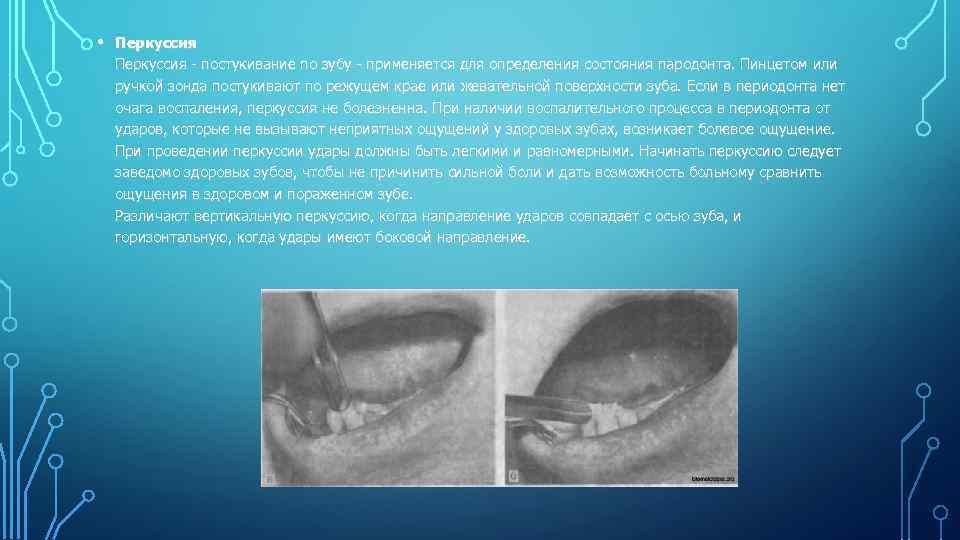 • Перкуссия - постукивание по зубу - применяется для определения состояния пародонта. Пинцетом