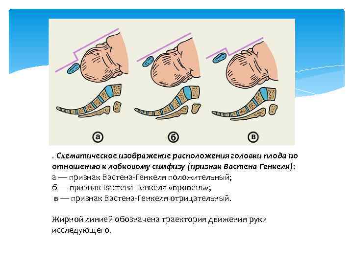 . Схематическое изображение расположения головки плода по отношению к лобковому симфизу (признак Вастена-Генкеля): а