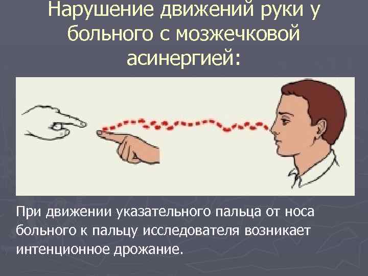 Нарушение движений руки у больного с мозжечковой асинергией: При движении указательного пальца от носа