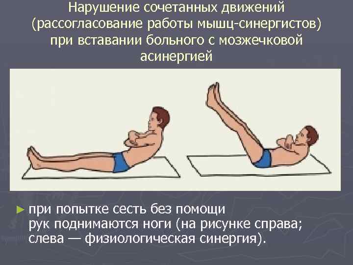 Нарушение сочетанных движений (рассогласование работы мышц-синергистов) при вставании больного с мозжечковой асинергией ► при