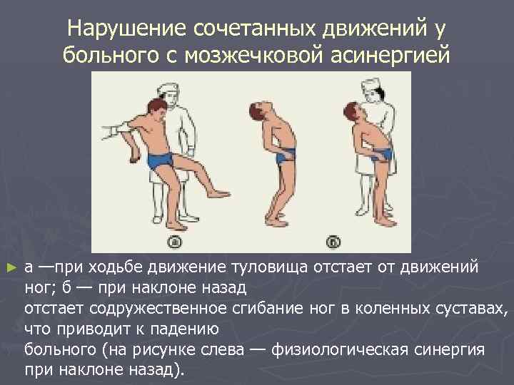 Нарушение сочетанных движений у больного с мозжечковой асинергией ► а —при ходьбе движение туловища
