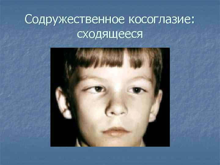 Содружественное косоглазие: сходящееся 