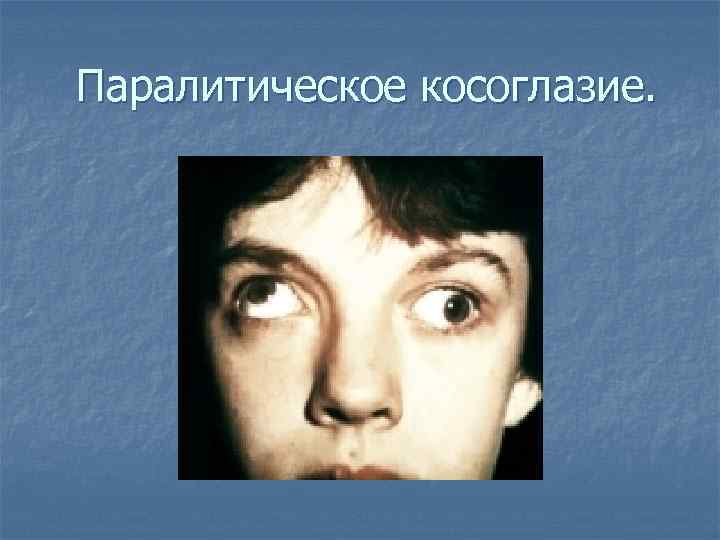 Паралитическое косоглазие. 