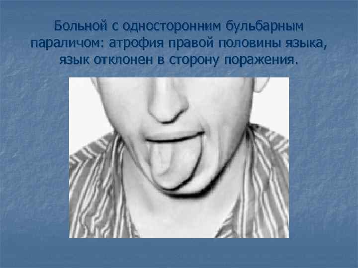 Больной с односторонним бульбарным параличом: атрофия правой половины языка, язык отклонен в сторону поражения.