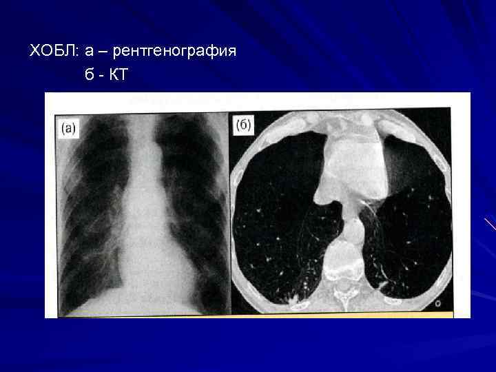 ХОБЛ: а – рентгенография б - КТ 