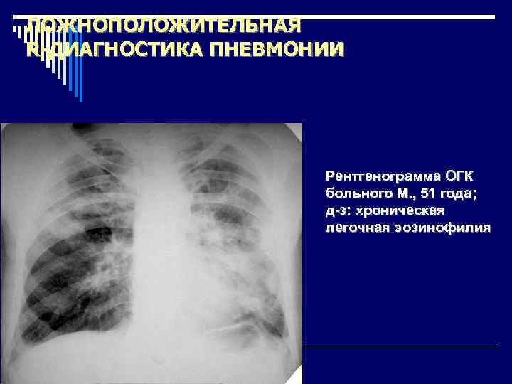 ЛОЖНОПОЛОЖИТЕЛЬНАЯ R-ДИАГНОСТИКА ПНЕВМОНИИ Рентгенограмма ОГК больного М. , 51 года; д-з: хроническая легочная эозинофилия