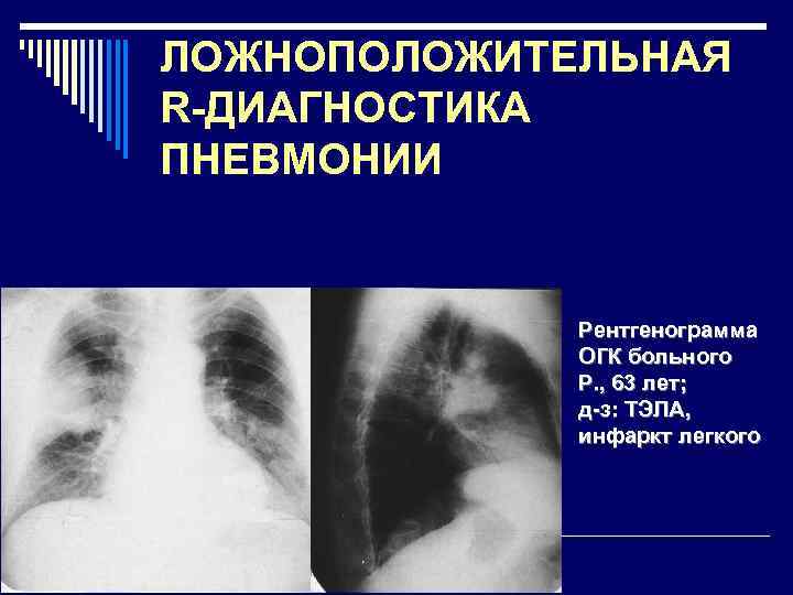 ЛОЖНОПОЛОЖИТЕЛЬНАЯ R-ДИАГНОСТИКА ПНЕВМОНИИ Рентгенограмма ОГК больного Р. , 63 лет; д-з: ТЭЛА, инфаркт легкого