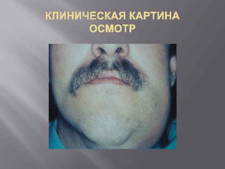 КЛИНИЧЕСКАЯ КАРТИНА ОСМОТР 