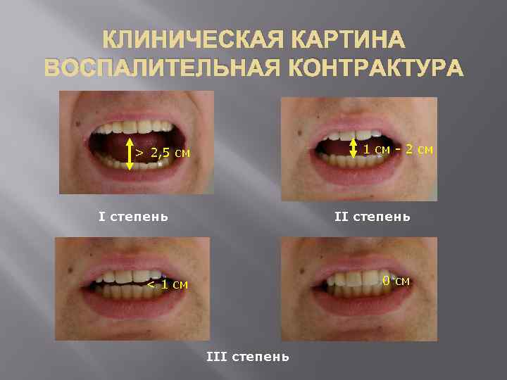 КЛИНИЧЕСКАЯ КАРТИНА ВОСПАЛИТЕЛЬНАЯ КОНТРАКТУРА 1 см - 2 см > 2, 5 см I