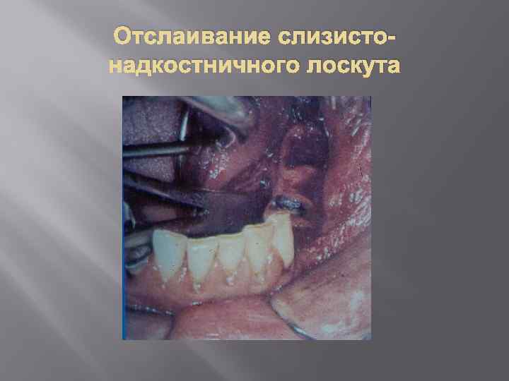 Отслаивание слизистонадкостничного лоскута 