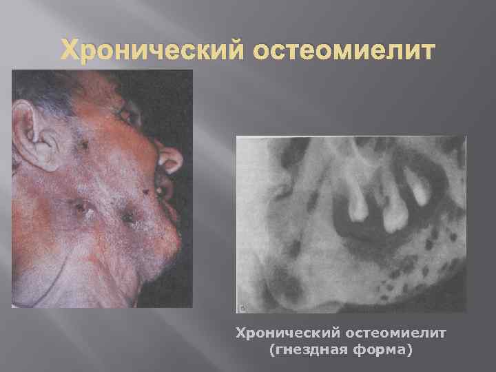 Хронический остеомиелит (гнездная форма) 