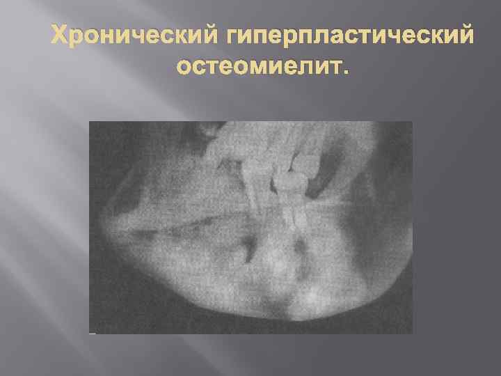 Хронический гиперпластический остеомиелит. 