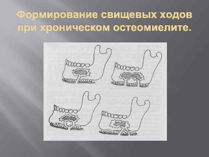 Формирование свищевых ходов при хроническом остеомиелите. 