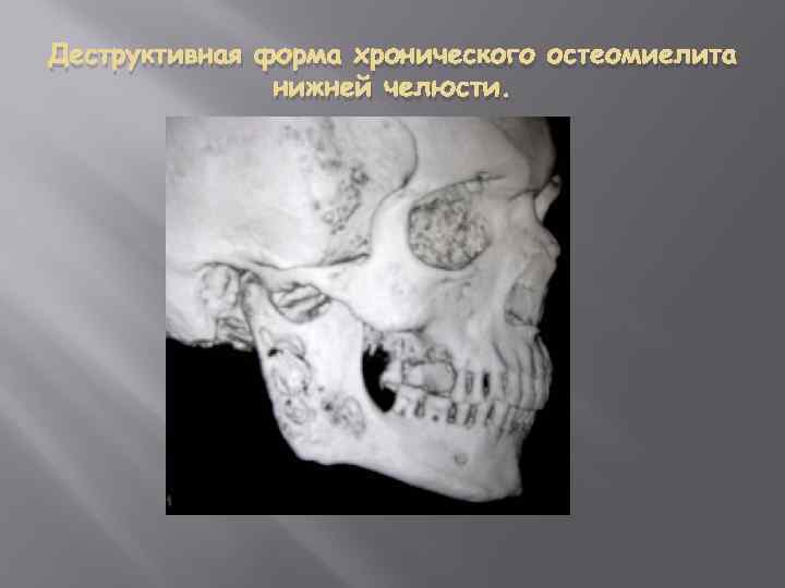 Деструктивная форма хронического остеомиелита нижней челюсти. 