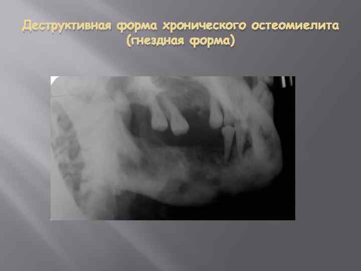 Деструктивная форма хронического остеомиелита (гнездная форма) 