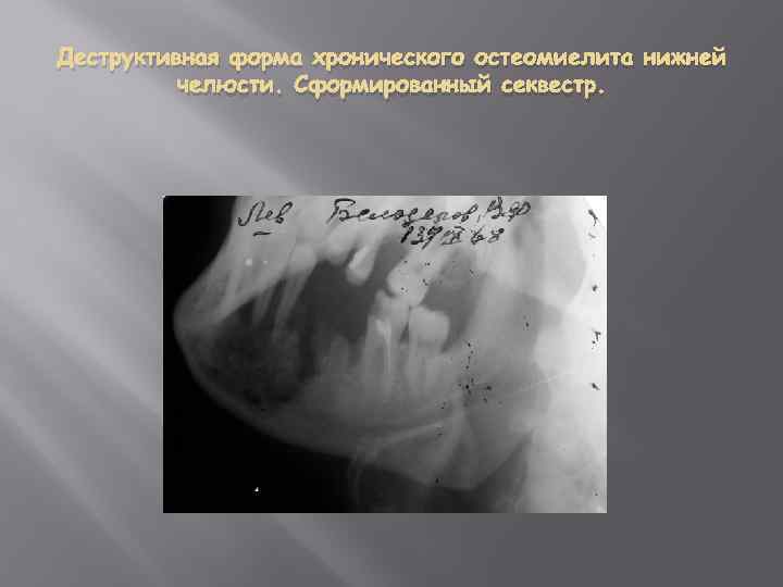 Деструктивная форма хронического остеомиелита нижней челюсти. Сформированный секвестр. 