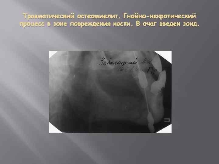 Травматический остеомиелит. Гнойно-некротический процесс в зоне повреждения кости. В очаг введен зонд. 